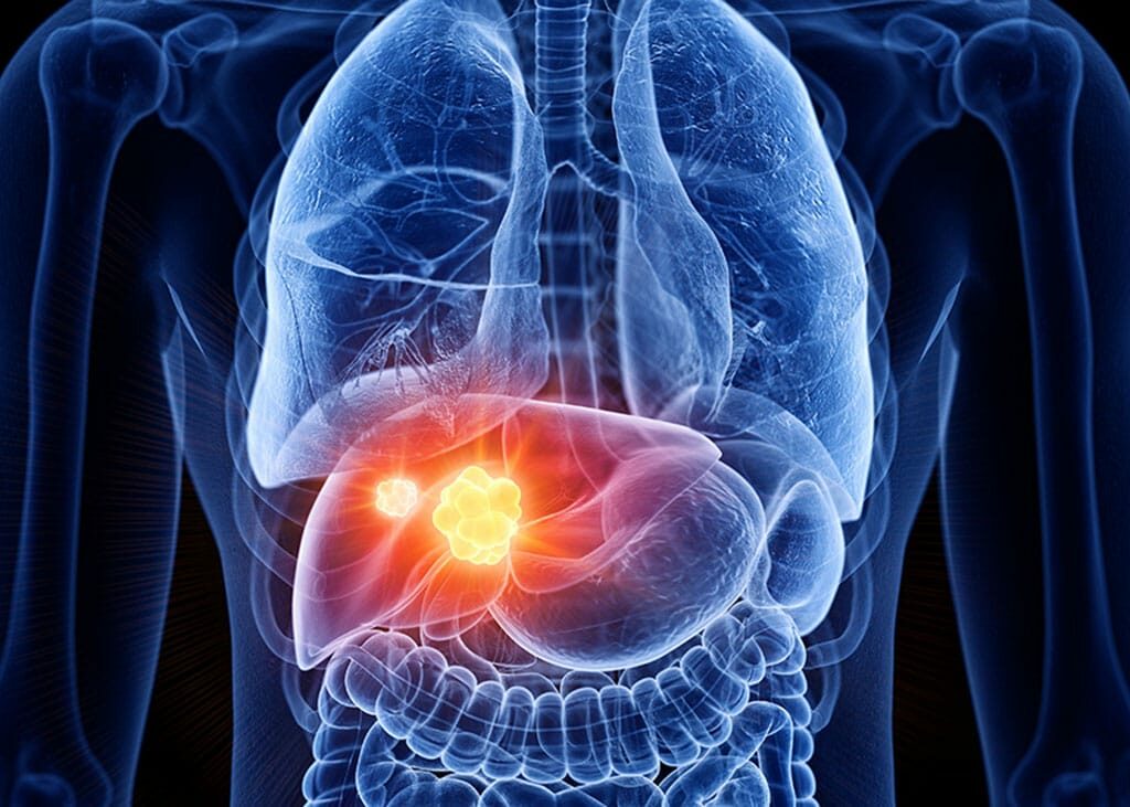 Liver-Cancer_-1024x731-2.jpg