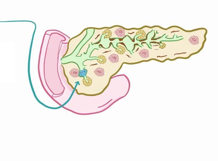 pancreatitis-2.jpg